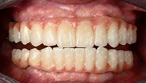 সম্পর্কে সর্বশেষ কোম্পানী কেস গ্রাহক কেস 4D জিরকোনিয়া ব্লক